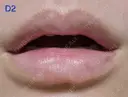 ヒアルロン酸注入（唇） 共立美容外科 新宿本院 DAY 2 サムネイル用