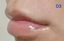 ヒアルロン酸注入（唇） 共立美容外科 新宿本院 DAY 3 サムネイル用