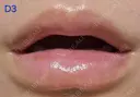 ヒアルロン酸注入（唇） 共立美容外科 新宿本院 DAY 3 サムネイル用