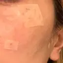 ルビーレーザー S-Laboクリニック 渋谷院 DAY 7 サムネイル用