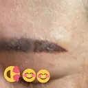 タトゥー除去 渋谷美容外科クリニック 池袋院 AFTER サムネイル用