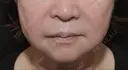 糸リフト / ヒアルロン酸注入（首） 藤・ナチュレ美容クリニック 銀座院 DAY 0 サムネイル用