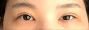 二重切開 / 目頭切開 / 上まぶたたるみ取り 湘南美容クリニック 大阪堺東院 DAY 85 サムネイル用