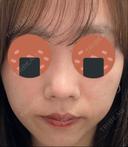 鼻尖形成（切開） / 軟骨移植 / 鼻尖縮小 / GLP-1ダイエット 東京シンデレラ美容外科 新宿院 AFTER サムネイル用