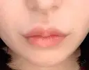 脂肪溶解注射（顔） / ヒアルロン酸注入（唇） ブルームクリニック（BLOOM CLINIC） AFTER サムネイル用