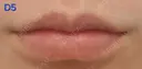 ヒアルロン酸注入（唇） 共立美容外科 新宿本院 AFTER サムネイル用