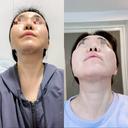 骨切り（あご） / 骨削り（エラ） / 骨削り（頬） セギム美容整形外科 DAY 41 サムネイル用