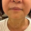 糸リフト / ヒアルロン酸注入（首） 藤・ナチュレ美容クリニック 銀座院 DAY 6 サムネイル用