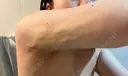 脂肪吸引（二の腕） / 脂肪吸引（肩） 湘南美容クリニック 大阪心斎橋院 DAY 27 サムネイル用