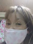 その他（目元） 品川スキンクリニック池袋院 DAY 11 サムネイル用