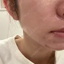 その他（肌） / 毛穴洗浄（ハイドラフェイシャルなど） / ニキビ治療 AURORA CLINIC（オーロラクリニック）新宿院 AFTER サムネイル用