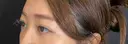 クマ治療 藤・ナチュレ美容クリニック 銀座院 DAY 28 サムネイル用