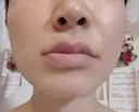 PRP皮膚再生療法 聖心美容クリニック 大宮院 DAY 1 サムネイル用