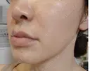 PRP皮膚再生療法 聖心美容クリニック 大宮院 DAY 1 サムネイル用