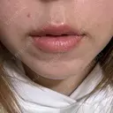 ヒアルロン酸注入（唇） / ボトックス（口角） / ヒアルロン酸注入（頬） / イオン導入 / ルメッカ ルラ美容クリニック 大宮院 / ルラスキンクリニック 大宮院 DAY 0 サムネイル用