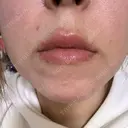 ヒアルロン酸注入（唇） / ボトックス（口角） / ヒアルロン酸注入（頬） / イオン導入 / ルメッカ ルラ美容クリニック 大宮院 / ルラスキンクリニック 大宮院 DAY 0 サムネイル用