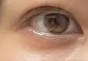 二重埋没 聖心美容クリニック 札幌院 DAY 10 サムネイル用