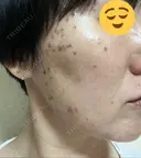 シミ取りレーザー / ピコスポット Olino美容外科・美容皮膚科 DAY 1 サムネイル用