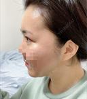 骨切り（あご） / 骨削り（エラ） / 骨削り（頬） セギム美容整形外科 DAY 45 サムネイル用