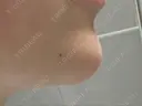 ヒアルロン酸注入（あご） BIZENNクリニック【ビゼンクリニック】 DAY 13 サムネイル用