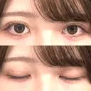 二重埋没 ルラ美容クリニック 渋谷本院 AFTER サムネイル用