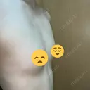 豊胸（脂肪注入） 銀座マイアミ美容外科 DAY 23 サムネイル用