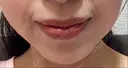 ヒアルロン酸注入（鼻翼基部） ルラ美容クリニック 名古屋本院 DAY 8 サムネイル用