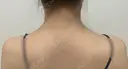 ボトックス（肩） / ボトックス（眉間） / ボトックス（額） ルラ美容クリニック 大阪本院 AFTER サムネイル用