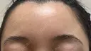 ボトックス（肩） / ボトックス（眉間） / ボトックス（額） ルラ美容クリニック 大阪本院 DAY 20 サムネイル用