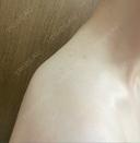 ボトックス（肩） 共立美容外科 名古屋院 DAY 1 サムネイル用