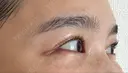 ボトックス（目尻） スキンリファインクリニック銀座 DAY 16 サムネイル用