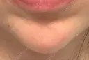 ヒアルロン酸注入（あご） BIZENNクリニック【ビゼンクリニック】 DAY 15 サムネイル用