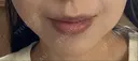 ヒアルロン酸注入（鼻翼基部） ルラ美容クリニック 名古屋本院 DAY 10 サムネイル用
