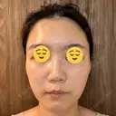 エレクトロポレーション 湘南美容クリニック Regno 銀座院 DAY 6 サムネイル用