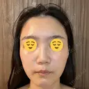 エレクトロポレーション 湘南美容クリニック Regno 銀座院 DAY 7 サムネイル用