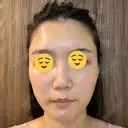 エレクトロポレーション 湘南美容クリニック Regno 銀座院 AFTER サムネイル用