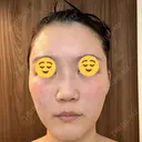 エレクトロポレーション / 光治療（フォトフェイシャルなど） DMTC CLINIC 日本橋院 DAY 3 サムネイル用