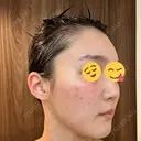 エレクトロポレーション / 光治療（フォトフェイシャルなど） DMTC CLINIC 日本橋院 DAY 3 サムネイル用