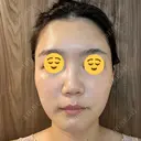 エレクトロポレーション / 光治療（フォトフェイシャルなど） DMTC CLINIC 日本橋院 DAY 5 サムネイル用