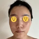 エレクトロポレーション / 光治療（フォトフェイシャルなど） DMTC CLINIC 日本橋院 DAY 7 サムネイル用