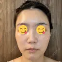 エレクトロポレーション / 光治療（フォトフェイシャルなど） DMTC CLINIC 日本橋院 DAY 8 サムネイル用