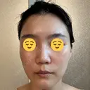 エレクトロポレーション / 光治療（フォトフェイシャルなど） DMTC CLINIC 日本橋院 DAY 9 サムネイル用