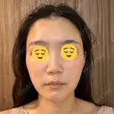 エレクトロポレーション / 光治療（フォトフェイシャルなど） DMTC CLINIC 日本橋院 AFTER サムネイル用