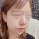 鼻尖形成（切開） / 軟骨移植 / ヒアルロン酸注入（鼻） / ヒアルロン酸注入（あご） ASTRA BEAUTY CLINIC DAY 3 サムネイル用