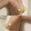 豊胸（シリコン＋脂肪併用） Casa de GRACIA GINZA 【カーサデグラシアギンザ】 DAY 253 サムネイル用