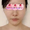 糸リフト / 脂肪吸引（顔） 東京美専クリニック AFTER サムネイル用