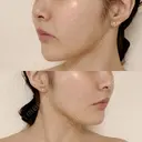 糸リフト / 脂肪吸引（顔） 東京美専クリニック DAY 85 サムネイル用