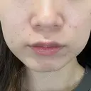 エレクトロポレーション / ピーリング（ハリ・ツヤ） LIFIX BEAUTY CLINIC AFTER サムネイル用