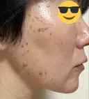 シミ取りレーザー / ピコスポット Olino美容外科・美容皮膚科 DAY 4 サムネイル用