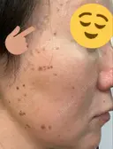 シミ取りレーザー / ピコスポット Olino美容外科・美容皮膚科 DAY 6 サムネイル用